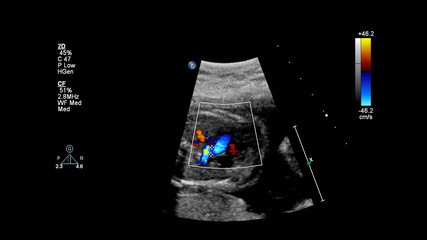 Ultrasound screen with fetal echocardiography.