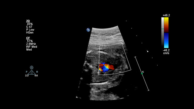 Ultrasound screen with fetal echocardiography.