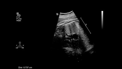 Ultrasound screen with fetal echocardiography.