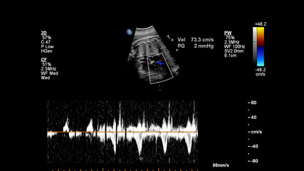 Obraz premium Ultrasound screen with fetal echocardiography.