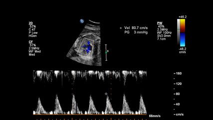 Ultrasound screen with fetal echocardiography.