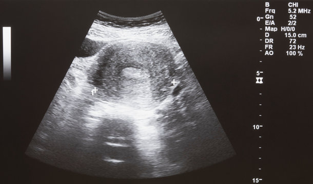 Ultrasound of baby in pregnant woman
