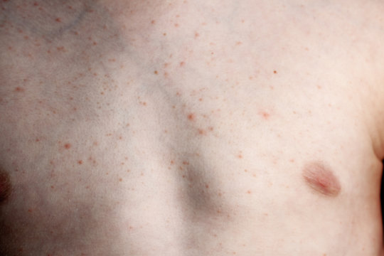 Close up image of a little boy's body suffering severe urticaria, nettle rash also called hives