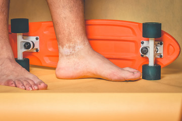 Man's feet with skin pigmentation problems on the ankle