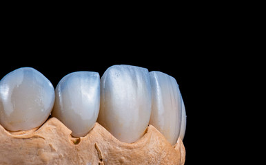 press ceramic crowns and veneers