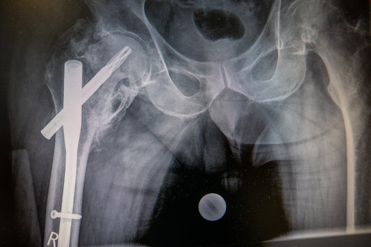 X-ray of a hip with an implanted femoral nail