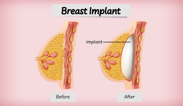 Anatomy of human breast implant