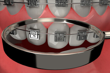 3D rendering from a dental brace check with a stomatoscope, closeup - 374325263