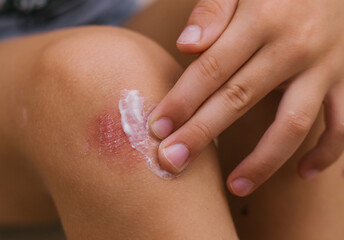 The child smears cream on the skin irritation. Care of the skin.