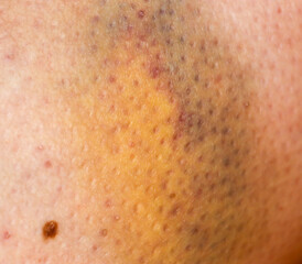 Large bruise hematoma on the humans leg on the skin in different colors.