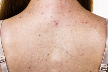 Woman with skin problem acne on back