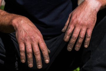 Tired , dirty, hard working caucasian man hands with a missing finger close up shot.