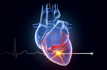 Cardiac infarction, myocardial infarction with ECG waves, medically artwork