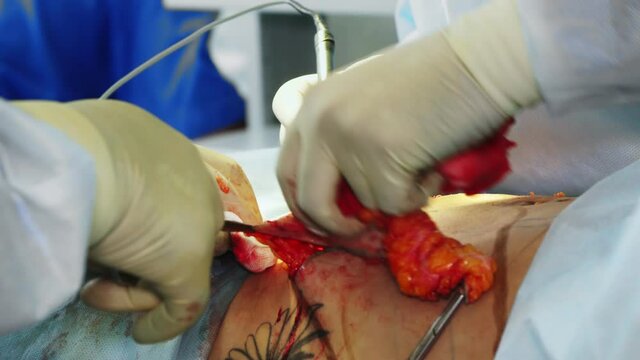 close-up. surgeon cuts out from patient a part of abdominal skin surface with a dense fat layer. surgery, abdominal liposuction in operating room, in hospital