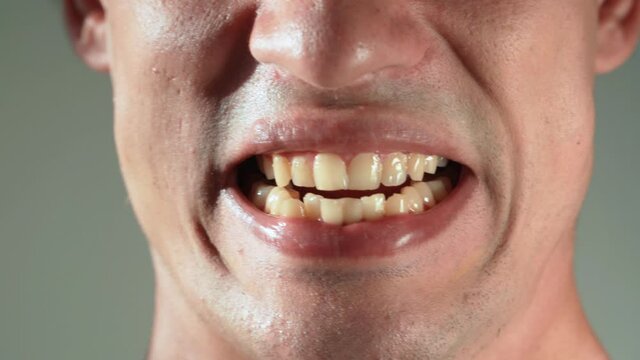 The man shows his yellow crooked and protruding teeth. Malocclusion. Close-up