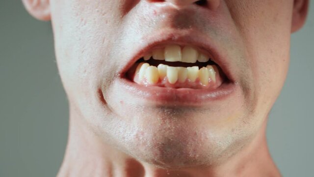 The man shows his yellow crooked and protruding teeth. Malocclusion. Close-up