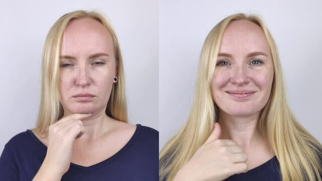 Second chin lift in women. Photos before and after plastic surgery, mentoplasty or facebuilding. Chin fat removal and face contour correction
