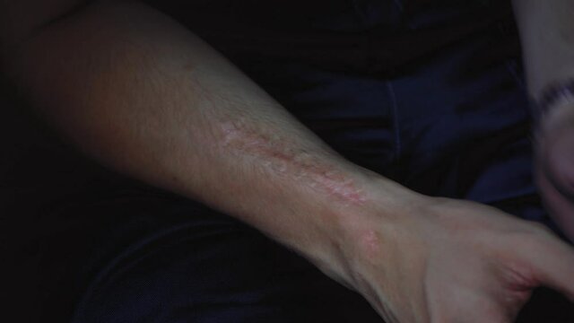 big scar on the man's arm