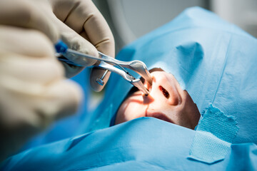 Functional rhinosurgery to restore nasal breathing with coblation technology.