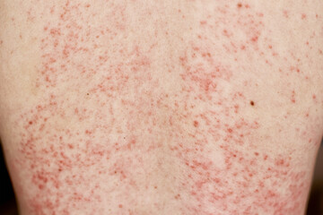 Fototapeta premium Allergic rash on skin. Woman with dermatology problem on back skin