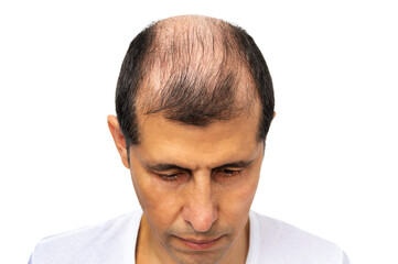 Obraz premium Hair loss concept. Head of man on white background, closeup