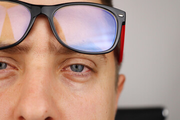 The man takes off his glasses and shows tired red eyes on a white background. Concept of eye fatigue from computer and fatigue from work. Pain in the eyes and forehead, migraine, eye diseases