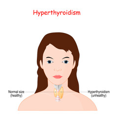 Hyperthyroidism. Woman with thyroid gland.