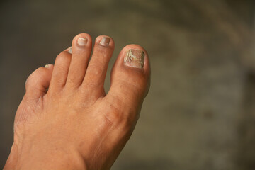 Close up of  toenail fungus, selective focusing
