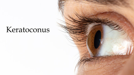 Macro eye photo. Keratoconus - eye disease, thinning of the cornea in the form of a cone. The...