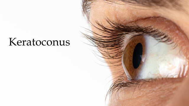 Macro eye photo. Keratoconus - eye disease, thinning of the cornea in the form of a cone. The cornea plastic. Close up, banner.