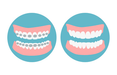 Before and after alignment teeth process. Alignment of bite of teeth, dental row  with braces, Orthodontic healthcare  concept. Vector illustration