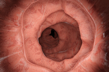 3D Illustration of a gastrointestinal polyp during Entersocopy - obrazy, fototapety, plakaty