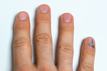 hand close-up with injured nail on little finger