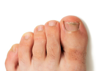 toes with nail fungus, on white background