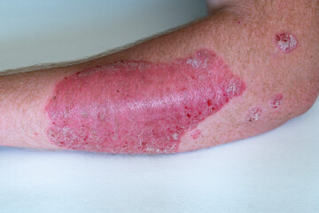 psoriasis on human hand, close-up, selective focus