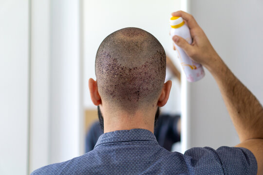 Man taking care his head with a spray after a hair implant