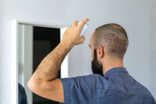 Man taking care his head with a spray after a hair implant
