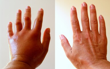 The left arm was severely swollen after a bee sting, which left its sting in the skin with poison.