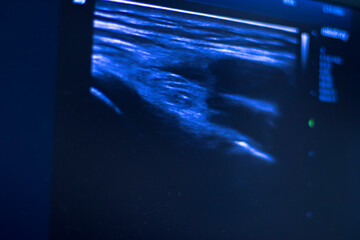 Obraz na płótnie Canvas EPI dry needling ultrasound scan
