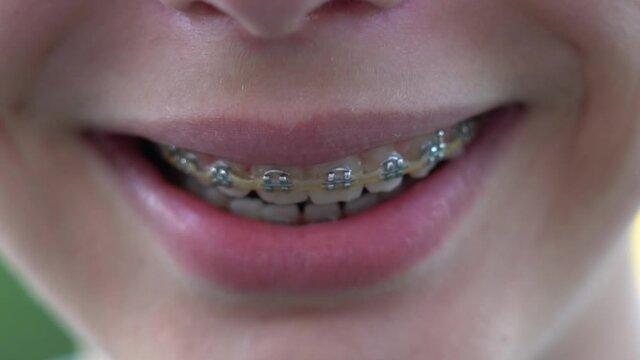 Close up view 4k video of smiling mouth of young white kid with overbite teeth with fixed metal modern braces construction on teeth.