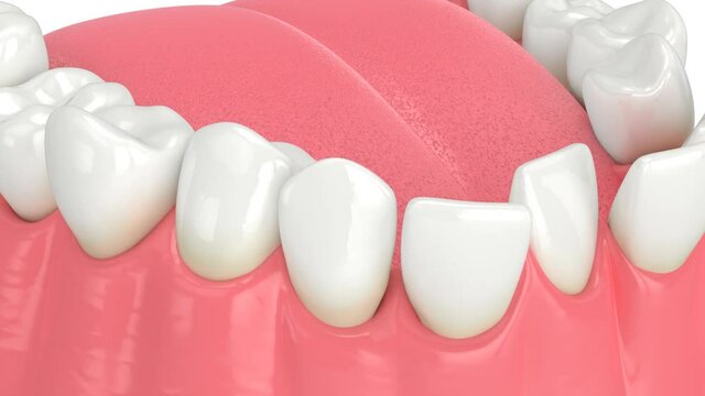 Abnormal teeth position. Orthodontic treatment concept. 
