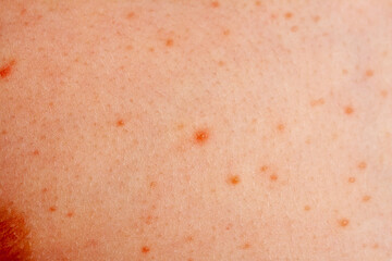 Close up image of a little boy's body suffering severe urticaria, nettle rash also called hives