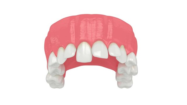 Upper jaw with abnormal teeth position. Orthodontic treatment concept. 