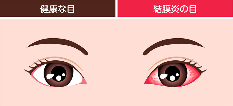 結膜炎と通常の目の比較イラスト
