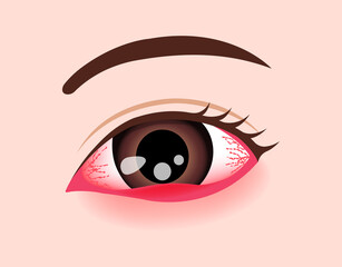 Eye disease vector illustration / Stye, Hordeolum