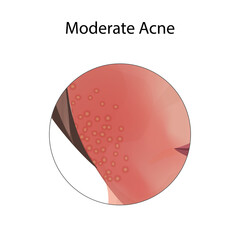 Moderate acne. Young woman face with skin inflammation. Close-up view.