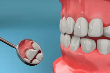 3D rendering from a dental check with a stomatoscope after brace remove, closeup - 375367253