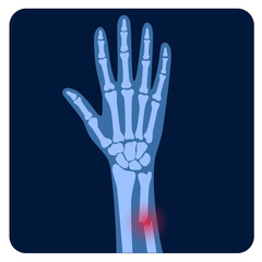 Fracture x ray concept