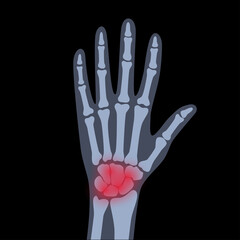 Arthrits x ray