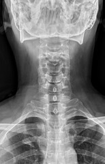 X-ray of cervical spine in anteroposterior position